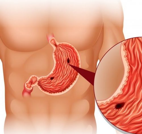 Duodenal Ülser Diyeti