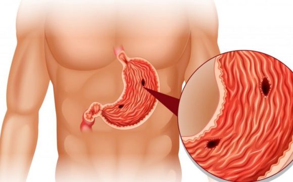Duodenal Ülser Diyeti