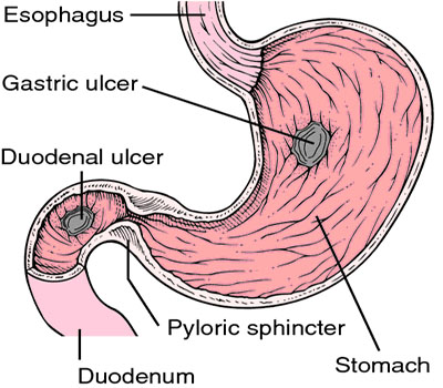 Duodenal Ülser