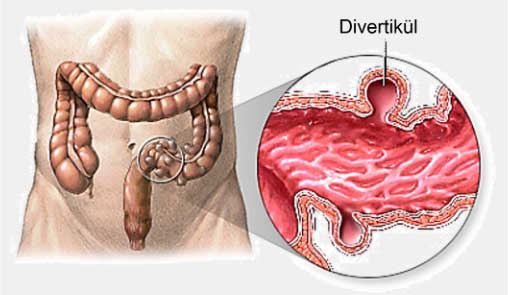 Divertiküler Hastalık