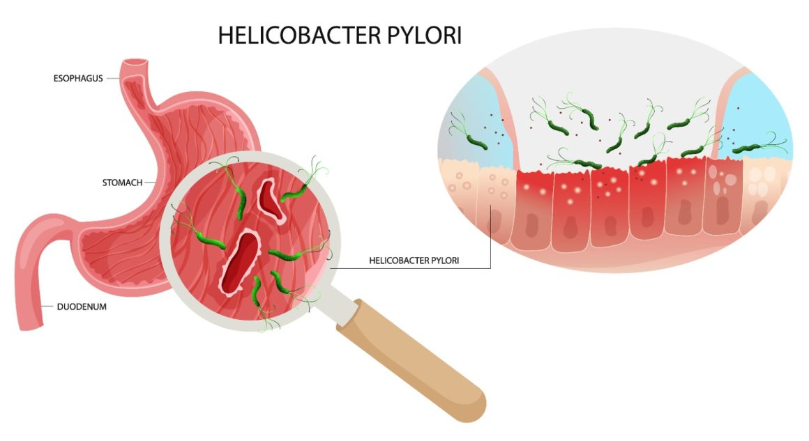 Helikobakter Pilori