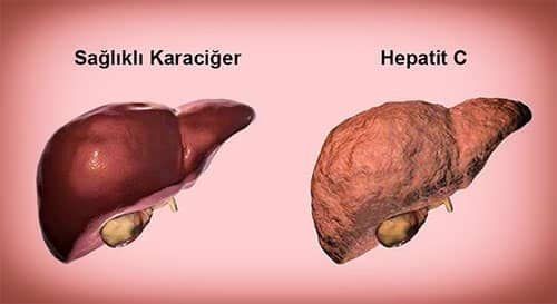 Hepatit C