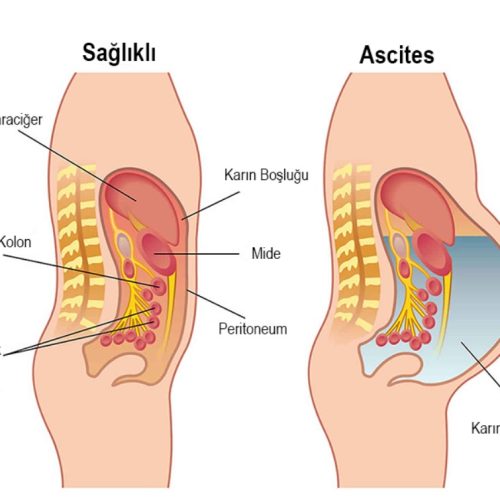Ascit