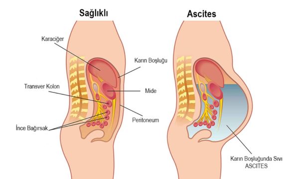 Ascit