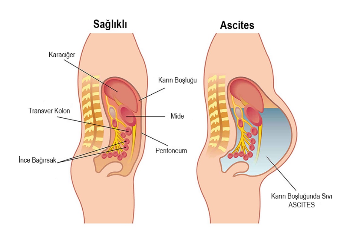Ascit Ascit