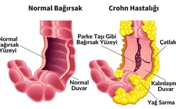 Crohn Hastalığı