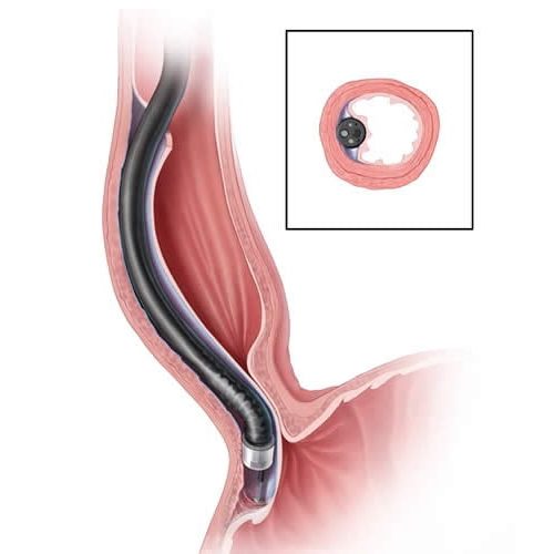 Akalazya (Achalasia)
