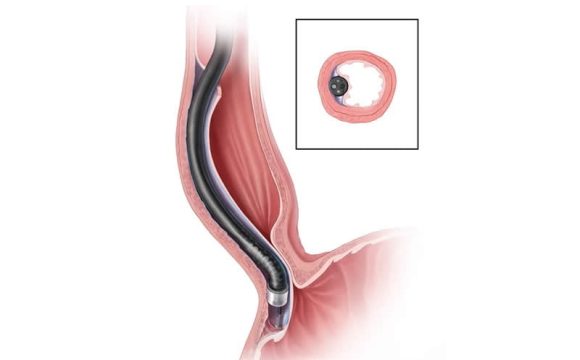 Akalazya (Achalasia)