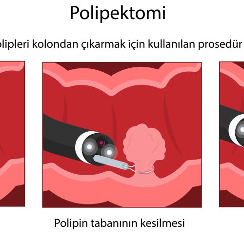 Kolon Polipleri