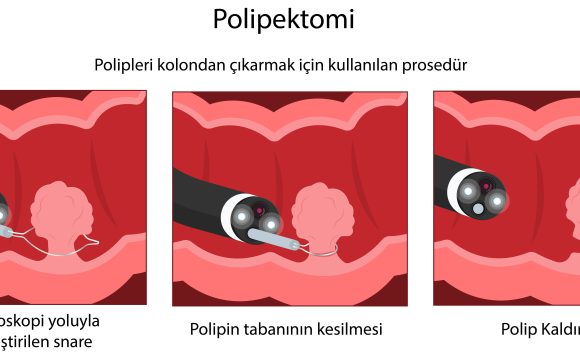 Kolon Polipleri