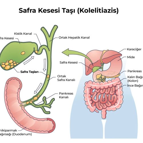Safra Kese Tasları