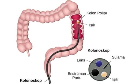 Kolonoskopi İşlemi