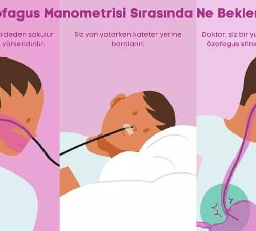 Özofajial Manometri