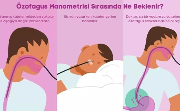 Özofajial Manometri