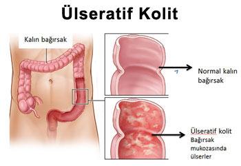 Ülseratif Kolit