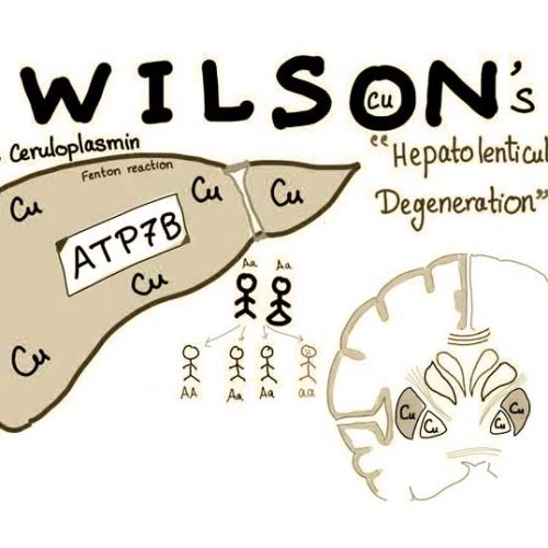 Wilson Hastalığı