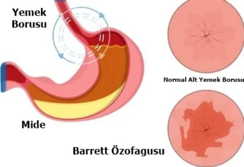 Barrett Özofagusu