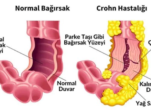 Crohn Hastalığı