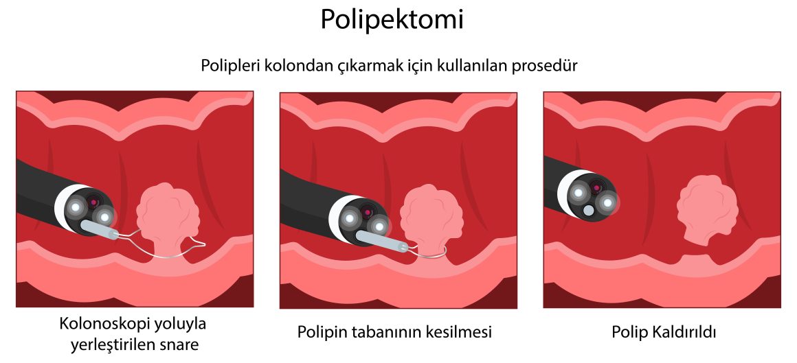 Kolon Polipleri