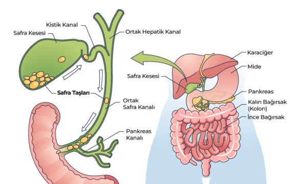 Safra Kese Tasları