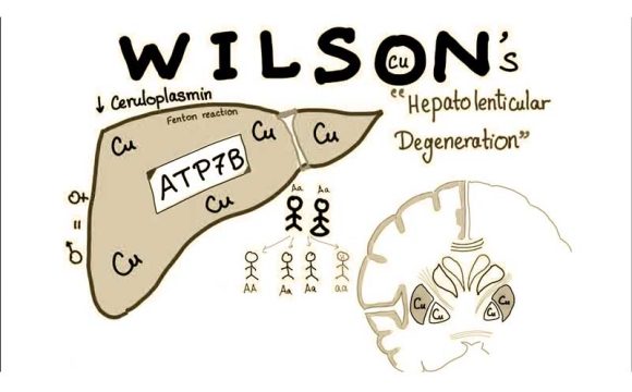 Wilson Hastalığı